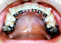 歯の裏側から行うめだたない治療方法